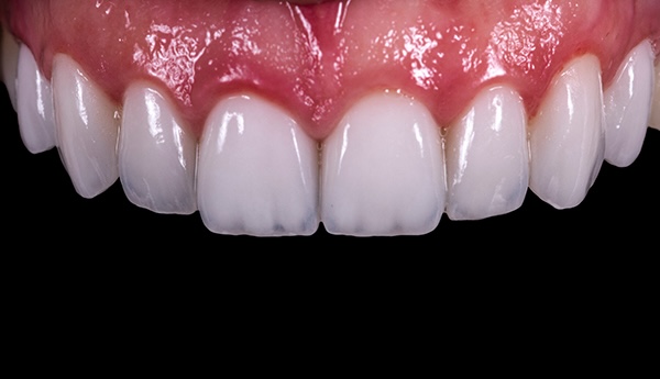 Közelkép egy fogról direkt héjjal, amely esztétikai fogászati eljárás során készült, a természetes és szép mosoly eléréséhez.