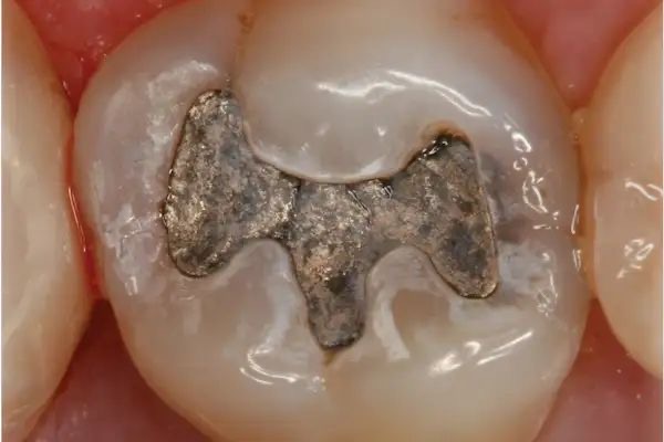 Amalgám tömés helyett esztétikus tömés